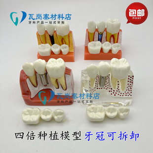 口腔牙模型 4倍种植解说模型 牙冠可拆卸种植钉展示模型 医患沟通