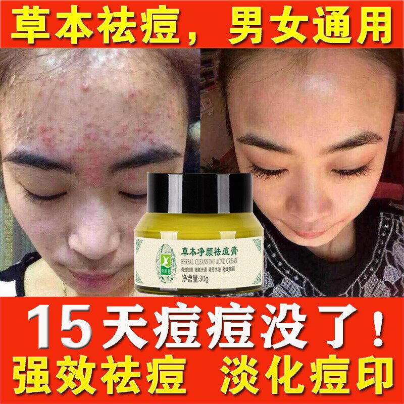 草本去豆膏脸上长痘下巴痘痘额头豆豆去除逗净擦消青春痘专用乳膏