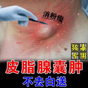 【囊肿一夜全愈】皮下皮脂腺囊肿痘痘堵塞去除拔毒膏药贴神器