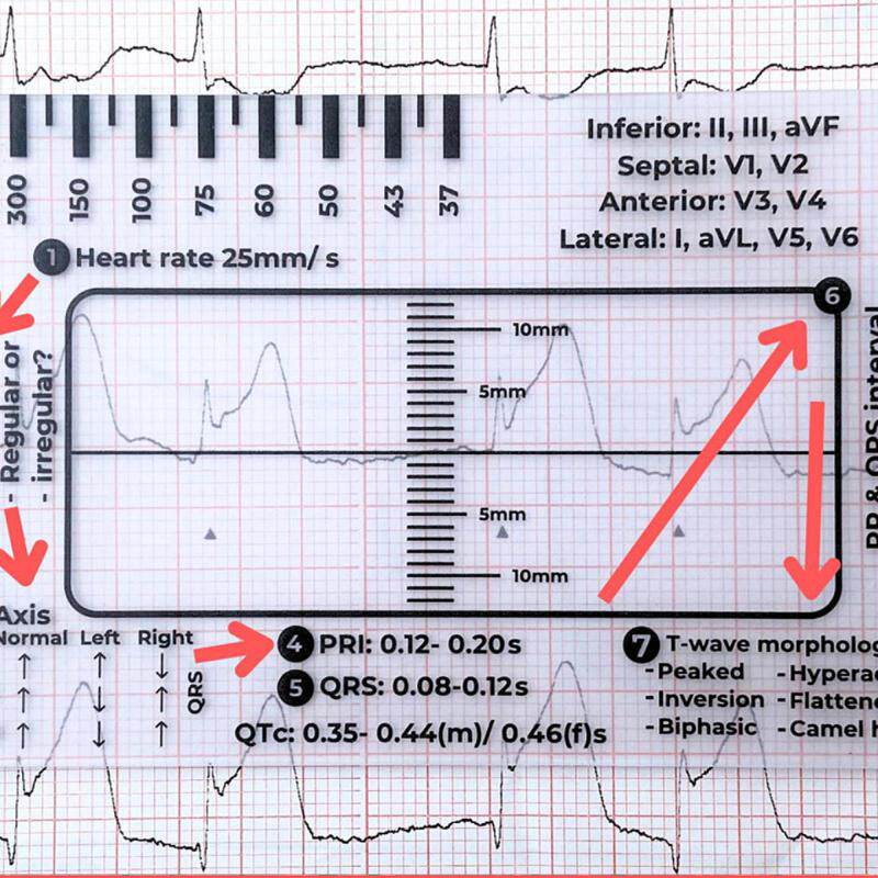 心电图7步尺 心电图解读辅助尺 查看心跳节律尺子 心电图简易解读,文具电教/文化用品/商务用品,制图/测绘套装,淘宝优惠券,粉丝福利购,淘宝优惠卷