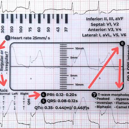 心电图7步尺 心电图解读辅助尺 查看心跳节律尺子 心电图简易解读