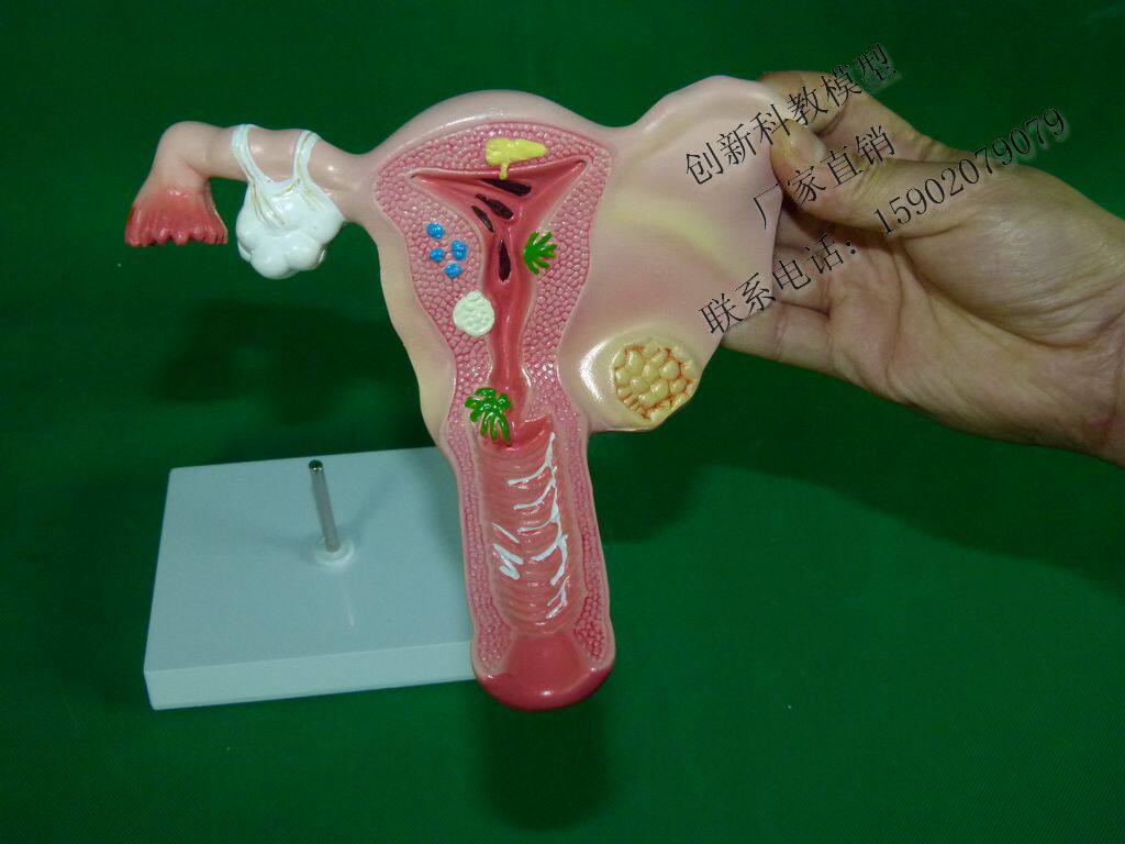 病变子宫模型 子宫病变模型 卵巢病变 生殖结构模型 病态子宫