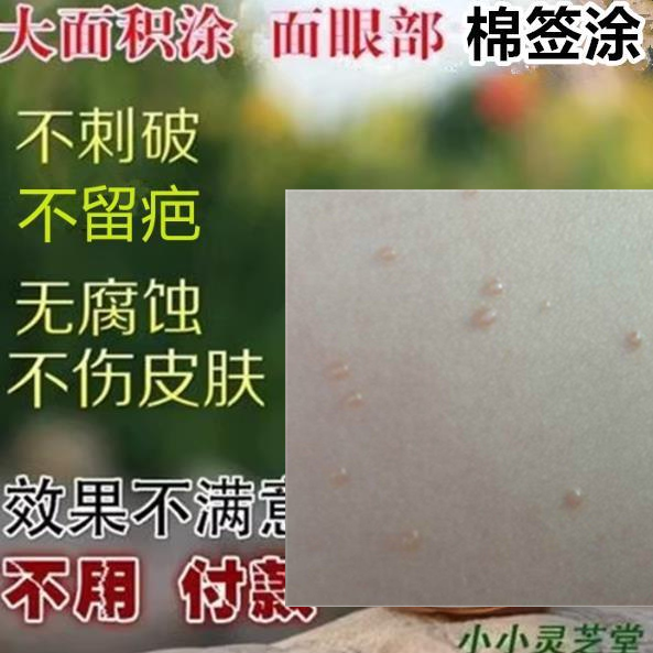 儿童传染性软疣水猴子病毒性软疣面部瘊子身上肉刺瘊子棉签涂温和
