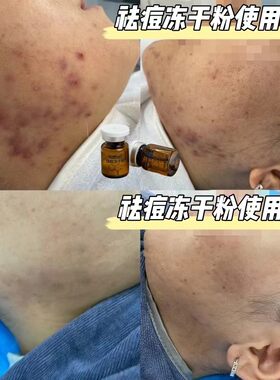 祛豆冻干粉一组 植萃水杨酸冻干粉 抗痘消yan去粉刺 控油收缩毛孔