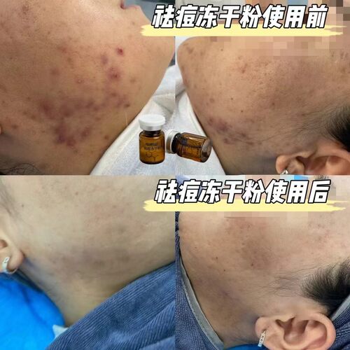 祛豆冻干粉一组 植萃水杨酸冻干粉 抗痘消yan去粉刺 控油收缩毛孔