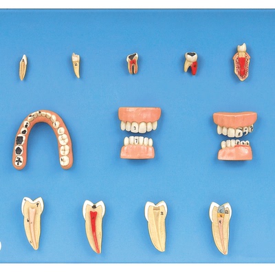 牙齿病变系列模型B10017