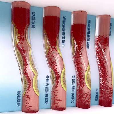 仿真动态血管模型高血脂血管流动堵塞对比动脉硬化血栓教学模型