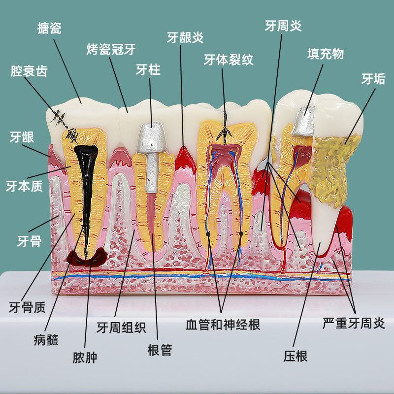 牙科口腔蛀牙龋齿牙病解剖模型牙齿结构模型幼儿园教学刷牙模型 玩具/童车/益智/积木/模型 其他模型玩具 原图主图