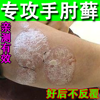 手肘癣胳膊肘病关节长藓痒顽固性皮癣神经性皮炎干屑燥起皮银药膏