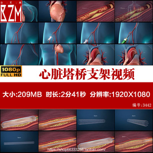 3D冠心病心脏塔桥支架血管堵塞心血管疾病血栓三维动画视频素材