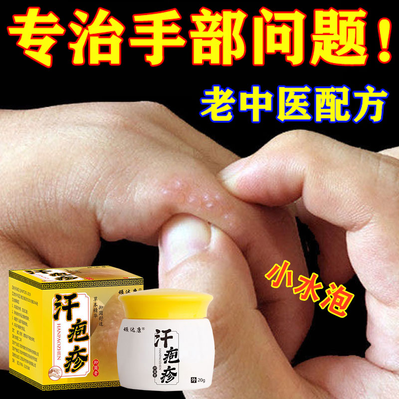 汗泡疱疹药膏汗疱疹汗状疱疹专用软膏鹅掌风汗孢疹手上小水泡汉疱