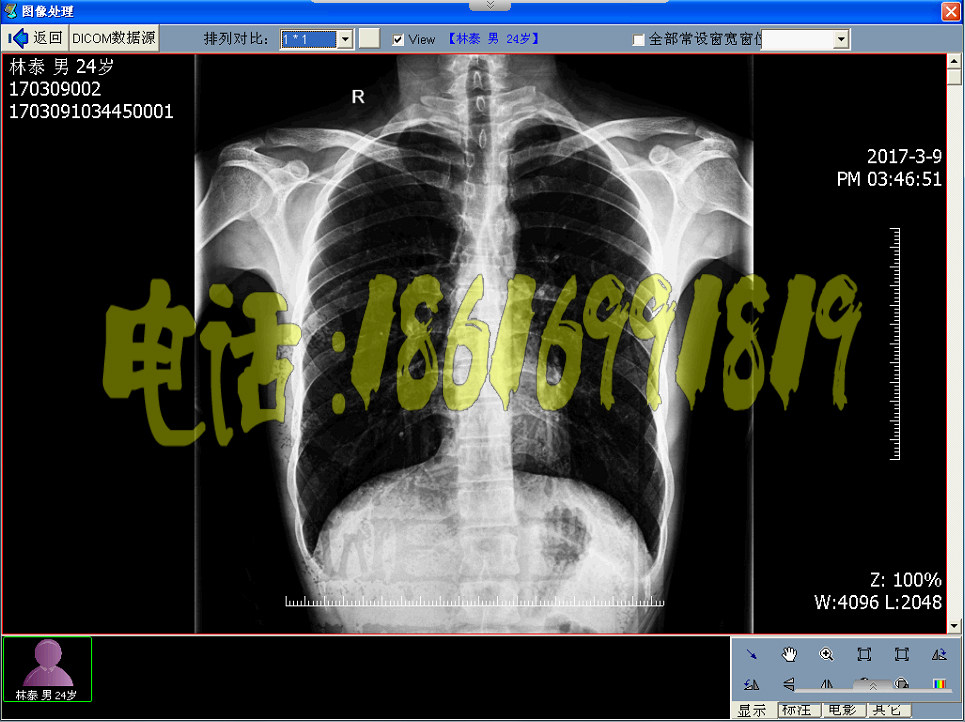 CT软件CT工作站X光机软件DR软件CR软件MRI软件DSA软件PACS系统