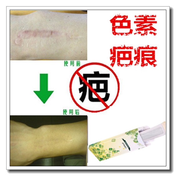 去黑色素沉着霜祛除抓痕暗沉红印淡化痘疤痕贴褪黑色素印沉淀回流