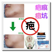 祛除手术烟烫软化增生性突起疙瘩消去破腹产伤疤痕印灵烟疤抓伤药