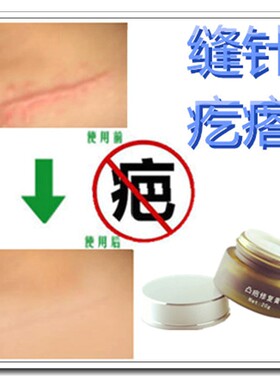 去除脸部增生性刀疤贴淡化烟烫伤疤痕印软膏修复手术缝针凹凸克星