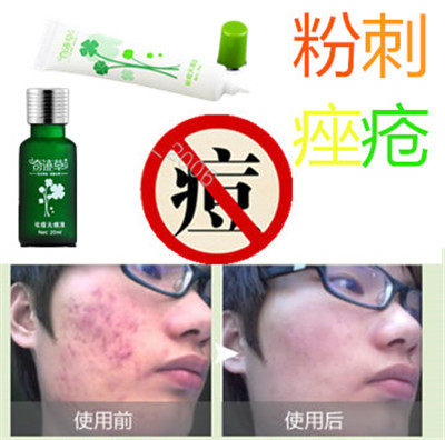 产品痘痘印痘疤去后背部修复霜胸前豆豆祛除男女士粉刺印暗疮正品