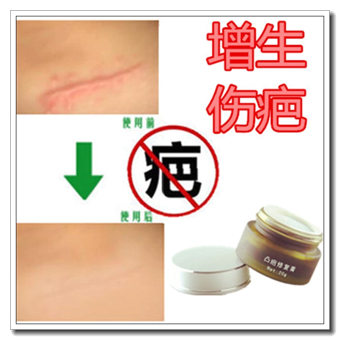 修复剖腹产后伤口药膏贴淡化黑色素祛儿童红印薰衣草精油去刀疤痕