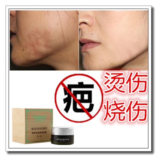 修复烟烫增生性体质软化烧伤凹凸巴疙瘩去手术后黑色素沉淀疤痕印