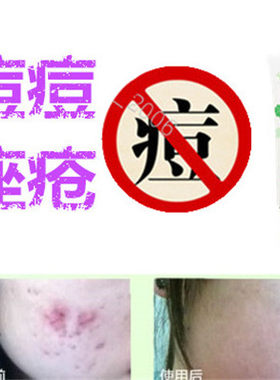 去除油性脂肪粒面疮酒刺舒缓敏感痤疮痘痘全清胸前豆豆痘痕平精华