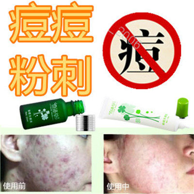 修复痘痘正品痘印痘疤痘坑青少年青春痘痤疮淡化疤痕黑头粉刺男女