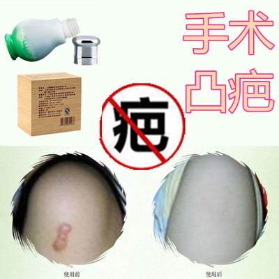 消除增生性突起缝针刀伤疤痕印淡化烟烫色素沉淀祛手术后摔伤疙瘩