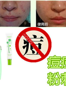 暗疮酒刺痤疮祛青少年痘痘印消除去额头豆印黑鼻头酒渣鼻修复乳霜
