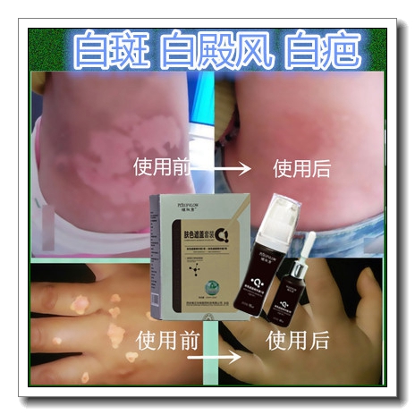 外用持久防水遮瑕膏祛面部白斑净白色疤痕去遮盖霜防水型白殿风液