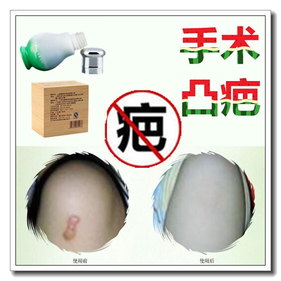 去耳洞增生凸起修复肚子纹身贴祛遮盖竖刀疤痕淡化暗沉硅凝胶敷料
