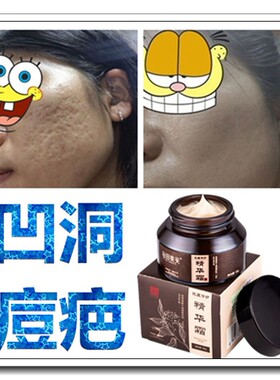 快速祛凹坑抚平凹疤修复去除儿童凹陷淡化痘坑痘疤痕灵药膏精华霜