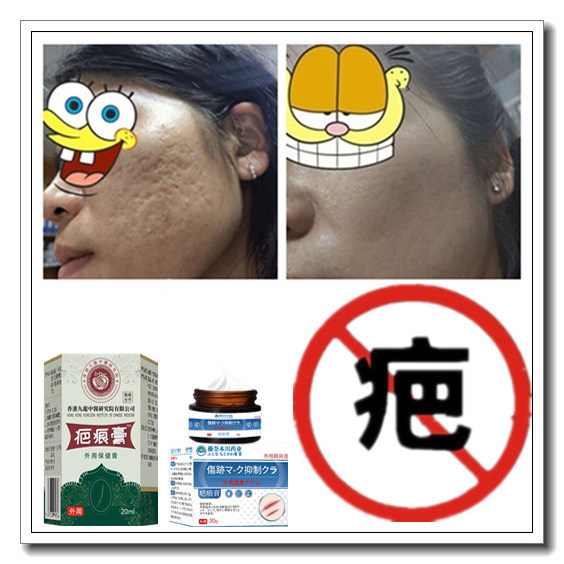 去除旧烟烫软化增生性疙瘩祛凹凸手术烧伤巴疤痕印黑色素沉淀药膏