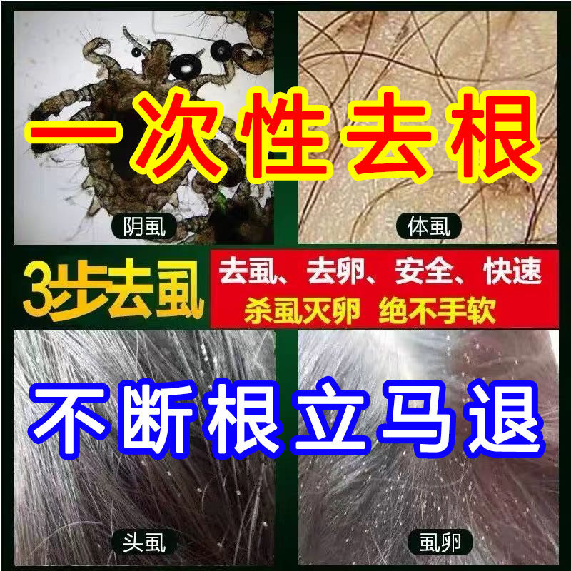 虱子药儿童头虱子大人用去除阴虱跳蚤灭小女孩头发长的虱卵一扫光