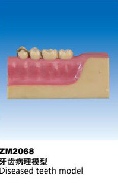 ZM2068牙齿病理解剖模型