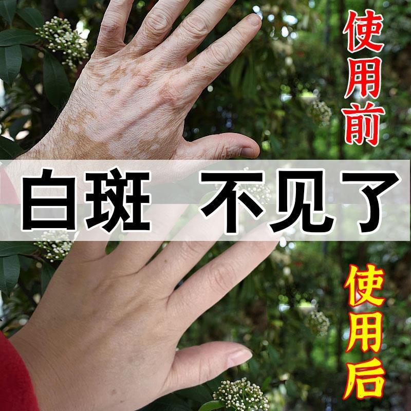 白癜风药膏快速消白斑专用遮盖液除去黑色素生长补骨脂酊神器克星