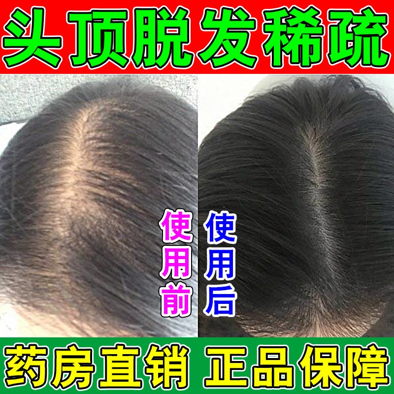 生发增发密发防脱发育发液头顶头发稀疏男女生快速增发精华喷雾酊