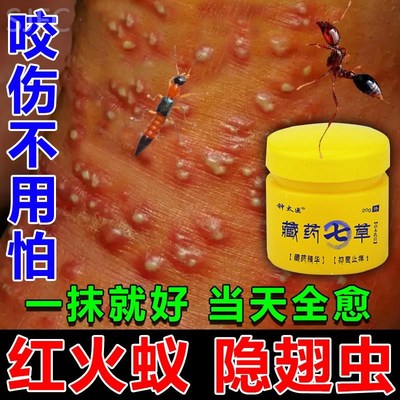 红火蚁蚂蚁咬伤药膏治户外蚊虫叮咬专用皮炎瘙痒止痒膏消红肿神器