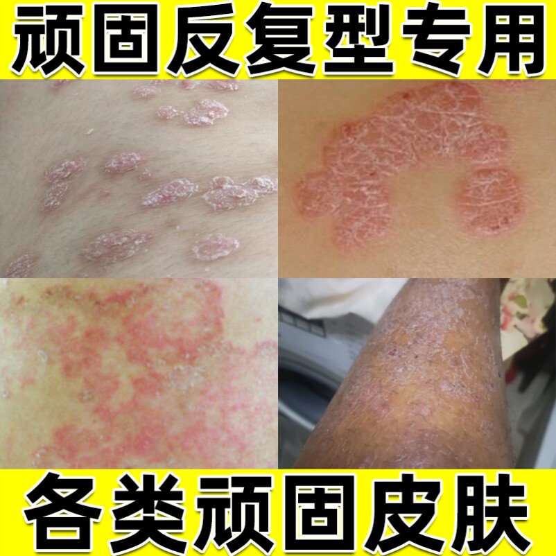 牛皮癣特效药膏手专用治干疮的药牛皮癣用药螨虫药膏后背药膏湿疹