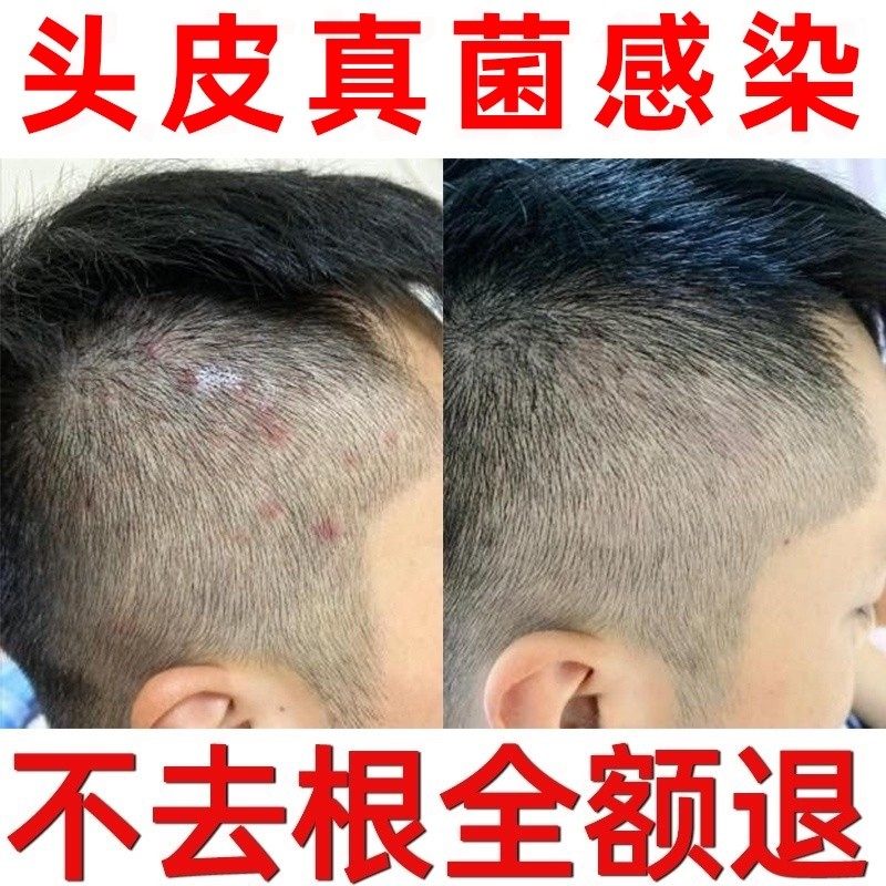头皮屑癣头皮真菌感染银屑癣外用头部去头藓头皮癣专用药膏洗发水