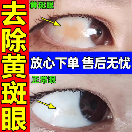 黄斑病变眼药水叶黄素眼白发黄眼睛清澈去黄红血丝眼底浑浊水肿