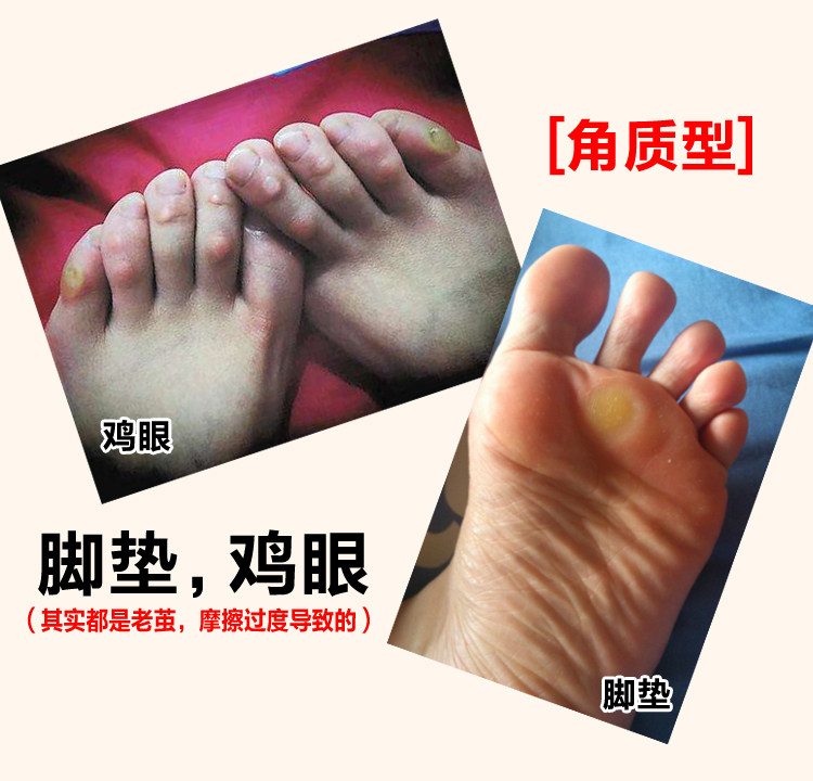 去除脚茧厚皮脚底老茧手茧祛去除皮肤消毒护理（消）