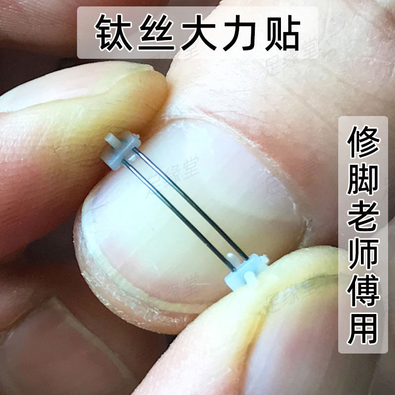 双丝镍钛合金正甲贴矫正钢丝甲沟美甲/修甲套装
