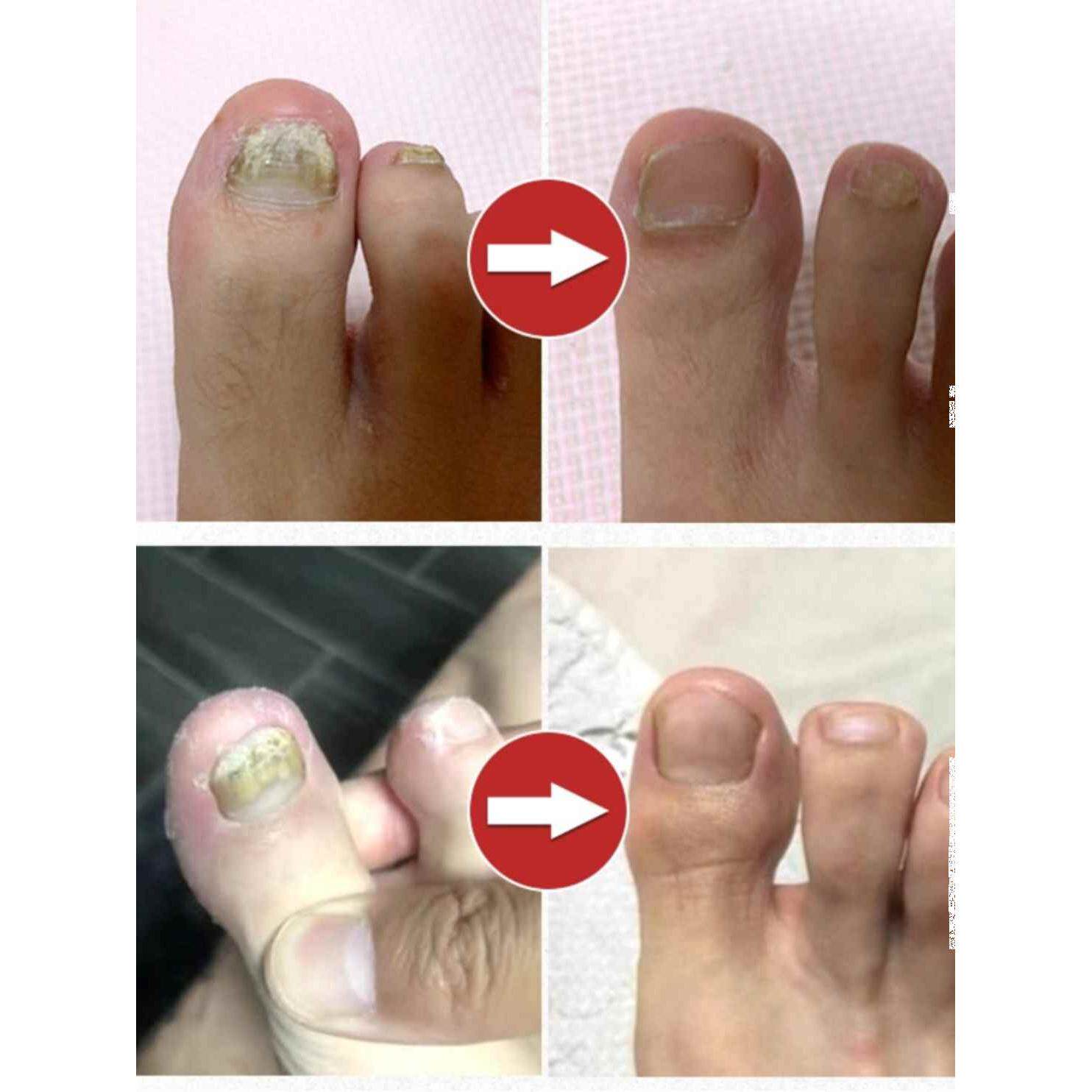 脚指甲增厚变黄灰甲神器脚趾甲变厚发黄变硬黄指甲盖坏甲变好甲药