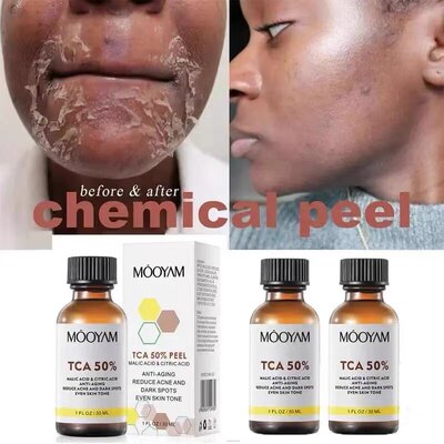 TCA 50% Chemical Peel Tca Peel Acid Skin Superforce Peel