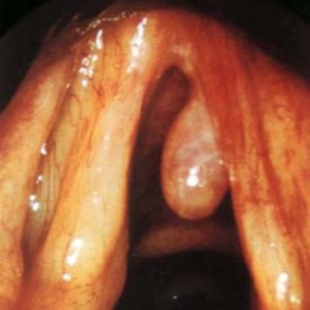 声带息接触性肉芽肿物小结肥厚声嘶咽痛沙哑高音上不去闭合不全炎