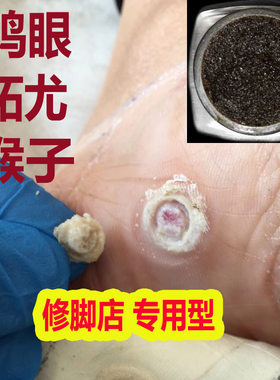 跖疣膏去猴子肉粒疙瘩手脚上长鸡眼膏贴寻常疣专用肉刺去除膏神器