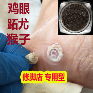 跖疣膏去猴子肉粒疙瘩手脚上长鸡眼膏贴寻常疣专用肉刺去除膏神器