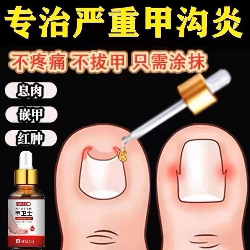 甲沟炎专用软甲嵌甲去肉芽脚趾矫指甲修护乳/霜
