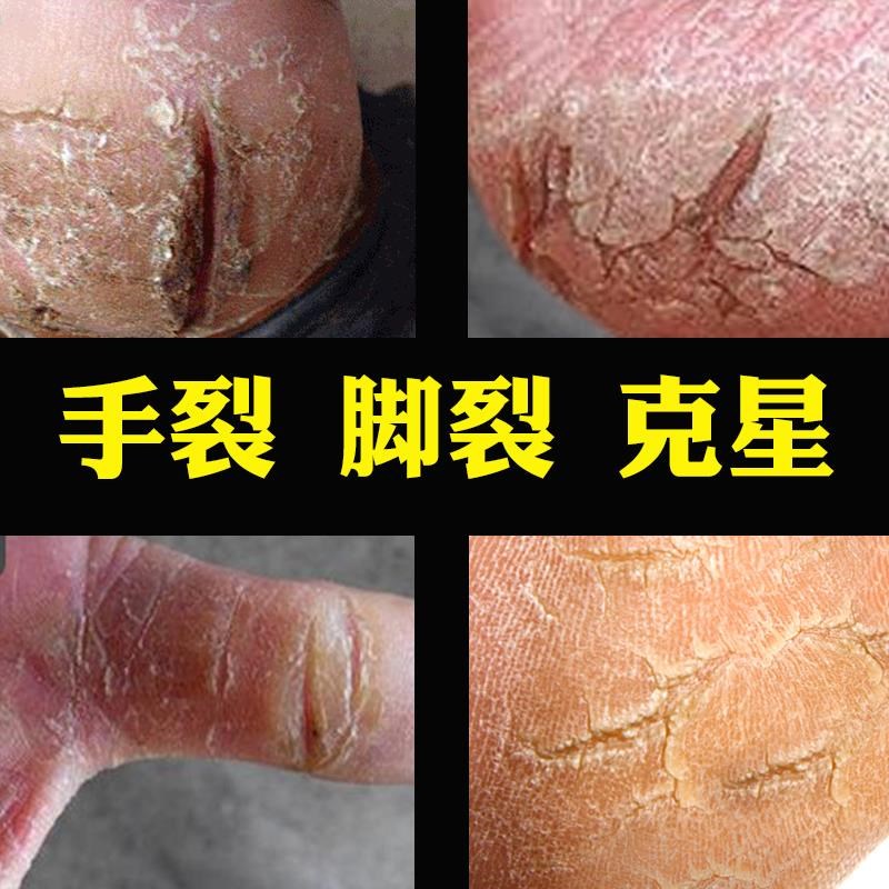 这个推荐脱皮握手尴尬小红书