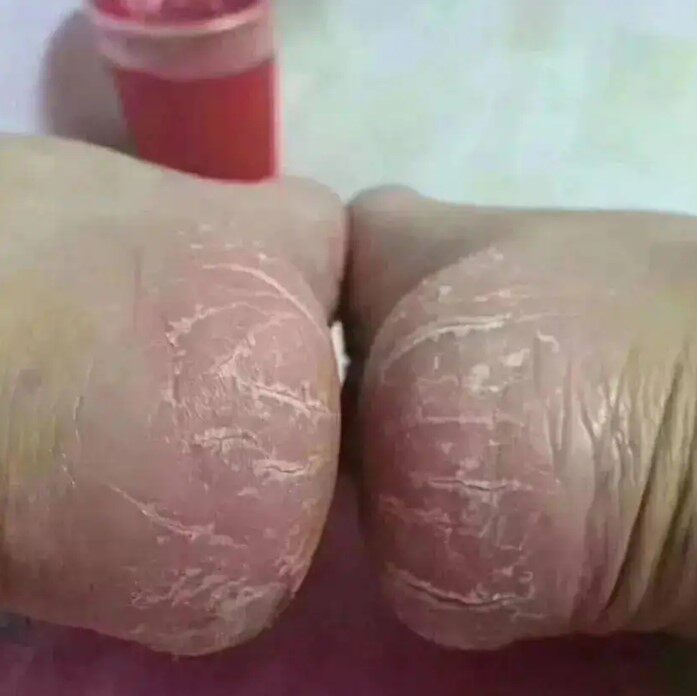脚心痒脚底上起小水泡又痒又脱皮药水泡型脚臭气真菌感染专用软膏