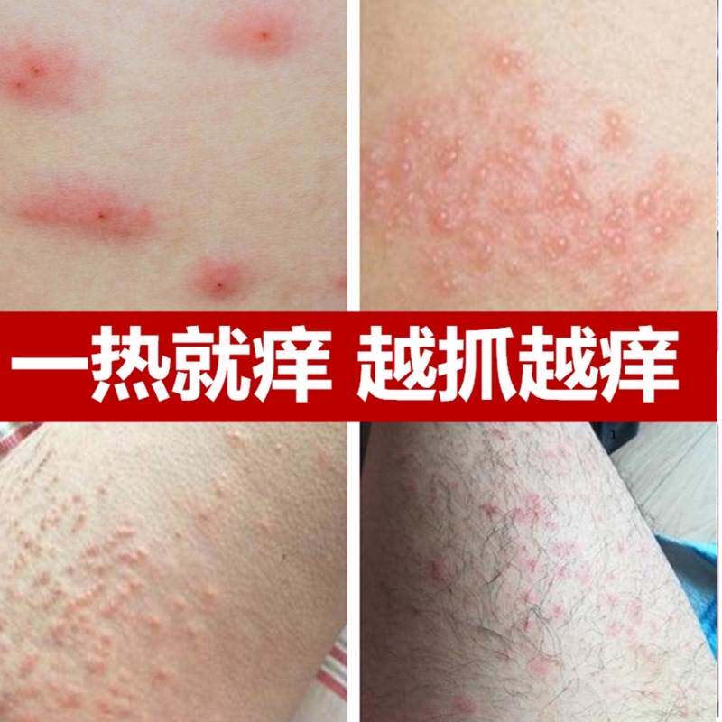 腋下淹了红肿疼痛夏天热胳瘙肢窝湿痒疹出汗多有异味发臭防摩擦膏