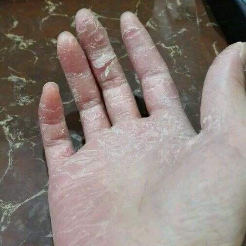 手足干裂口子细纹修复护手霜开裂脱皮裂开手足开口手脚秋冬皲裂膏